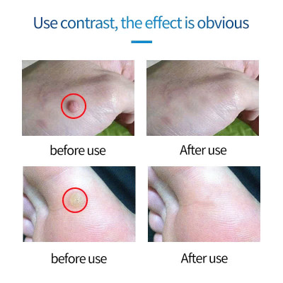 Kem Mụn Cóc, Mụn Thịt, Mụn Cơm Hiệu Quả – Chiết Xuất Thảo Dược An Toàn 20g, ĐÈN TRANG TRÍ , ĐỒNG HỒ TREO TƯỜNG