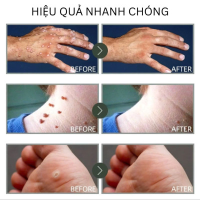 Kem Trị Mụn Cóc, Mụn Thịt, Mụn Cơm Hiệu Quả Sau 7 Ngày – Chiết Xuất Thảo Dược An Toàn 20g