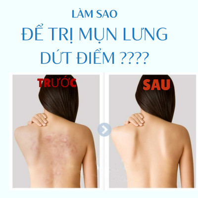 Gel Xịt Dưỡng Ẩm Ngăn Ngừa Mụn Lưng Pelican For Back Gel Mist (Chai 100 mL)